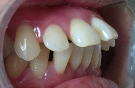 上门牙牙缝大前突美容修复