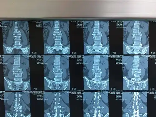 发现患者腰3椎体爆裂性骨折伴脱位,脊髓损伤,腰2,3,4椎体横突骨折
