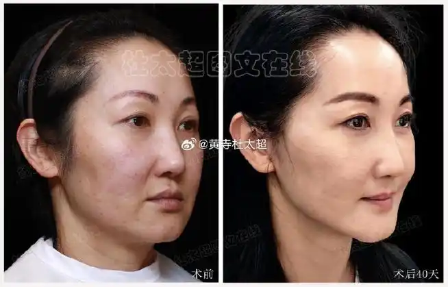 caw小切口面部提升##拉皮手术