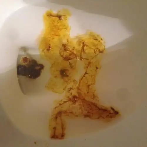 得了痔疮上厕所大便时会感到很痛之外,还可能会出现粘糊糊的排泄物