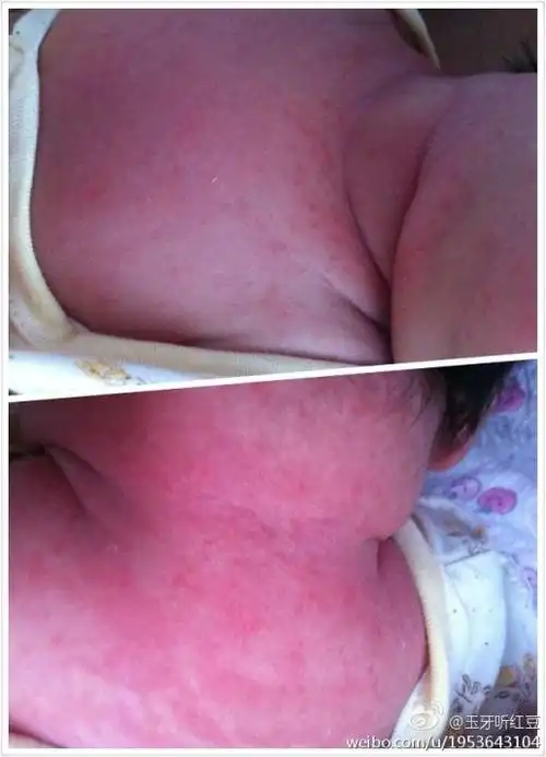 我的女宝宝二十二天了,脖颈处红红的,有的像痱子,但后脖颈处?