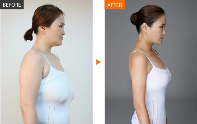 巨乳缩小术的患者先于站立位标记乳房下皱襞位置,整形后乳头位置及