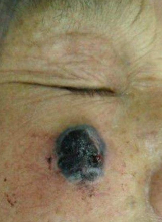 痣癌变的图片41