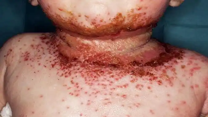 湿疹图片和症状 (49)