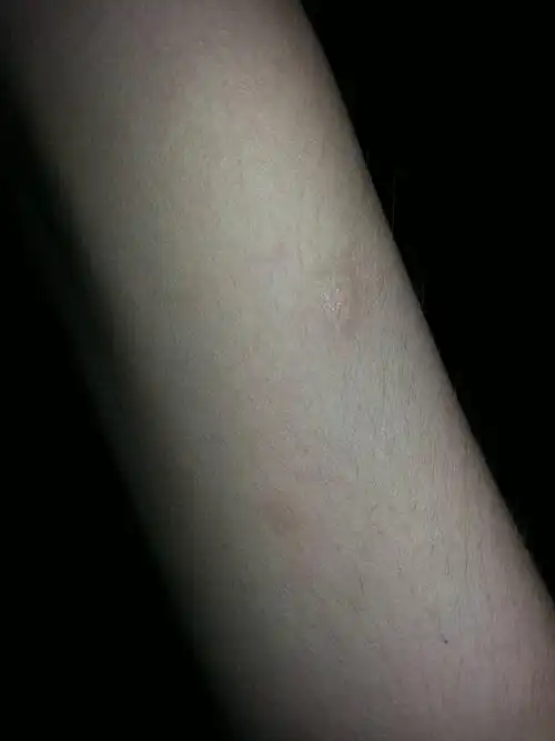 这个是什么呀,有点痒,脱皮后,新长出的皮肤是皱巴巴的.