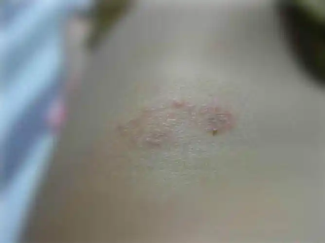 后背体股癣图片_有来医生