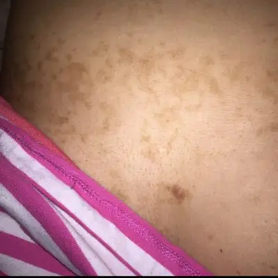 有没有宝妈和我一样,怀孕后乳房下面长褐色的斑,硬硬的,能抠掉皮的,不