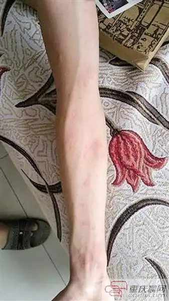 儿子游完泳,半夜全身起红疹奇痒难忍