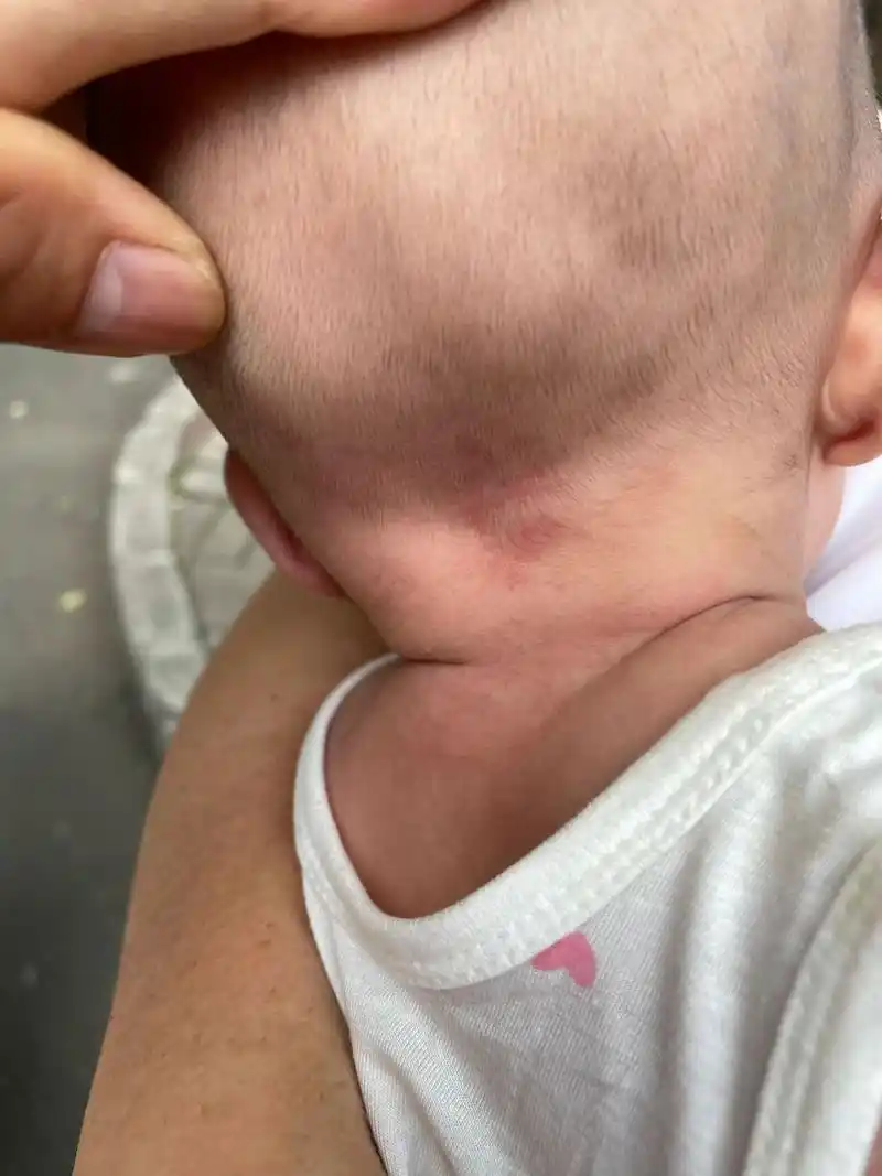 请亲们帮忙看看孩子后脑勺是不是血管瘤呢