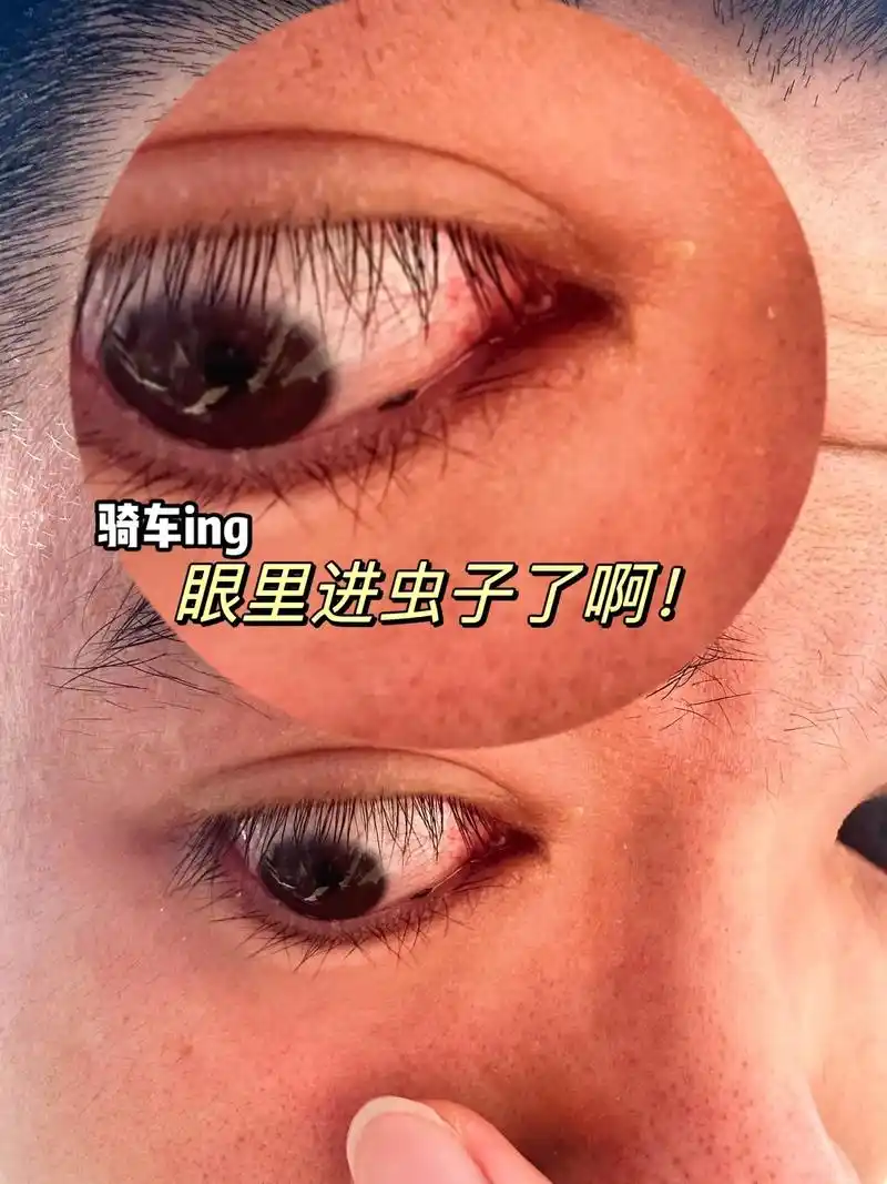 骑车眼里进虫子了啊,好痛哇.家人们谁懂啊,现在眼睛用洗眼液洗 - 抖音