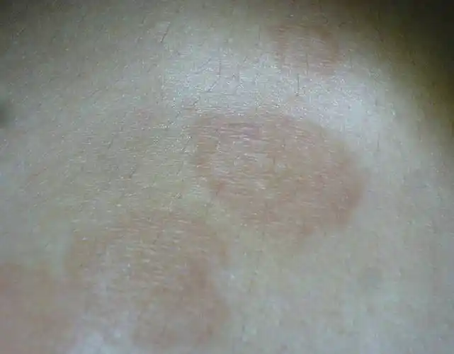 汗斑如何预防 荐5个有效治疗小妙招