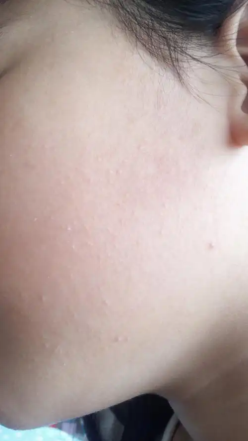 孩子脸上老是有小点点 这是什么呀?