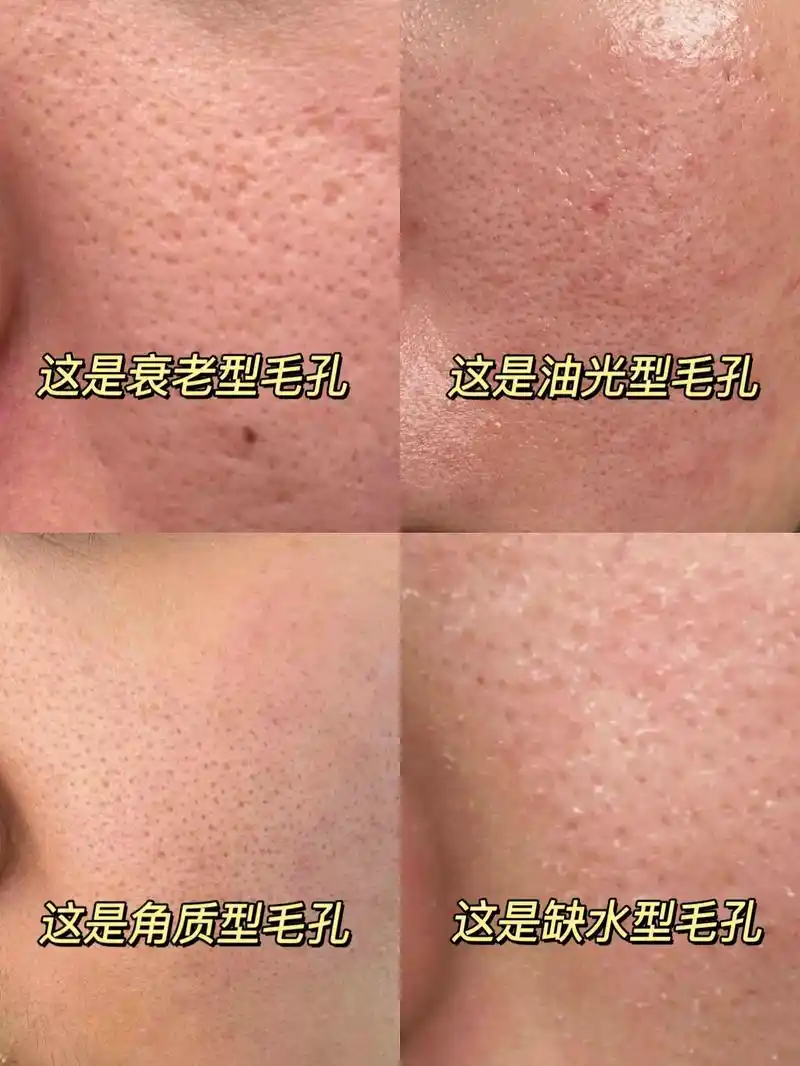 毛孔粗大的姐妹赶紧看啊