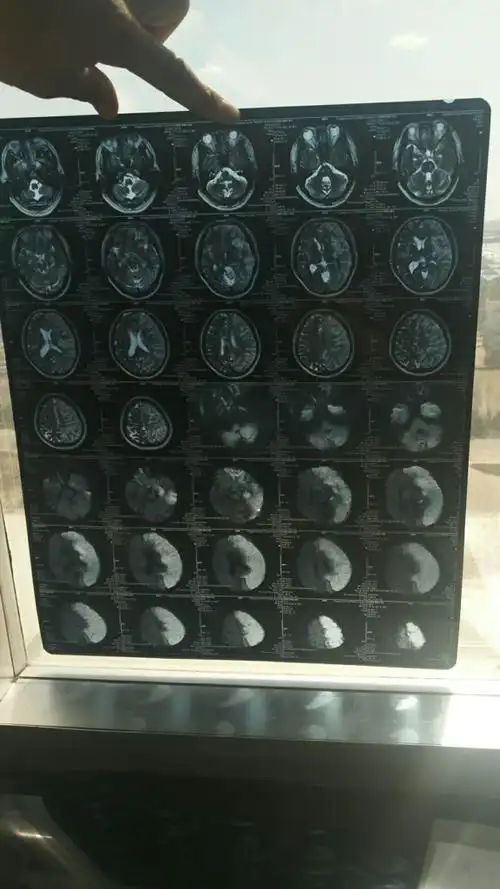 脑血栓溶栓治疗后,面积增大(附带片子)