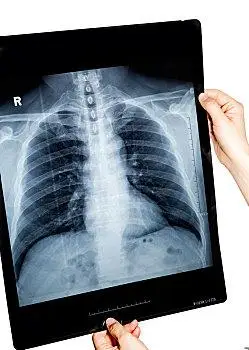 正常的肺部ct扫描照片