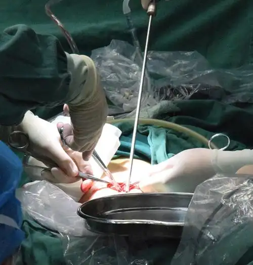 我院妇科又顺利完成一起利用单孔腹腔镜切除子宫肌瘤手术