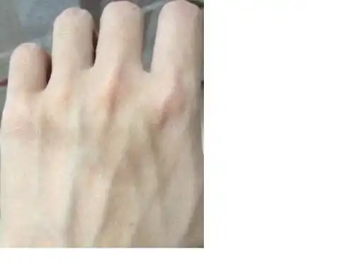 问:手背的黑皮肤如何消除