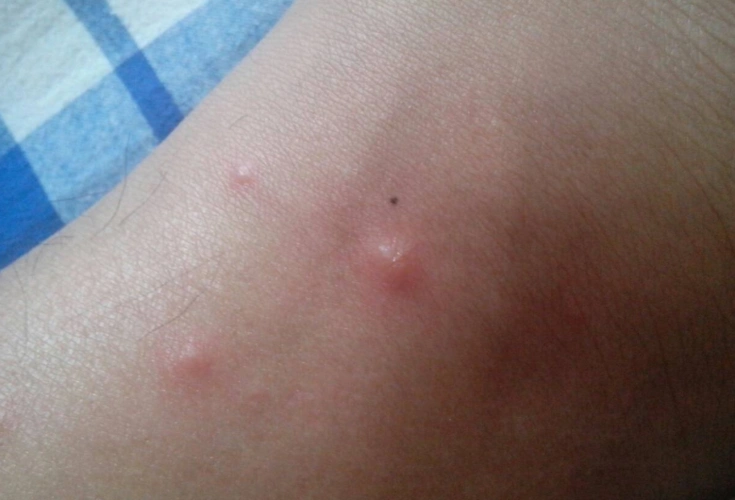 【丘疹图片】_表现症状_治疗方法_苹果绿