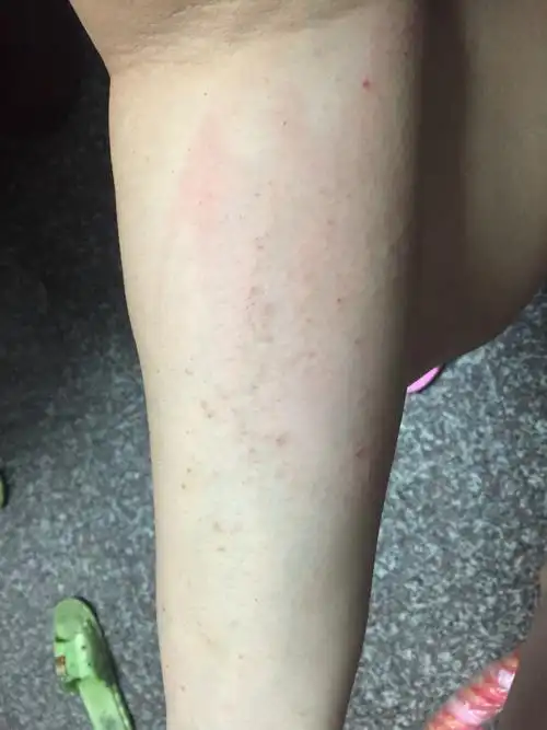 属于季节性皮肤病吗? 非常的痒,请问要怎么处理?求解决.