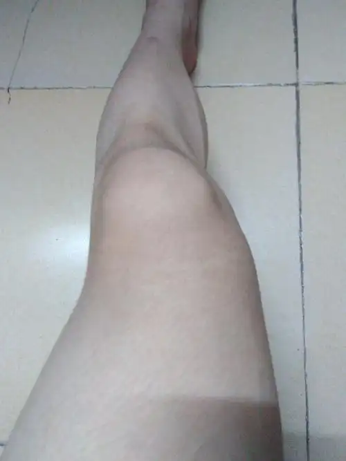 我的腿歪的有点严重了.有什么办法可以纠正啊