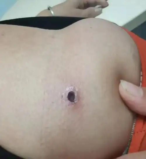 "蜱虫病"全称为发热伴血小板减少综合征,主要表现为全身不适,乏力