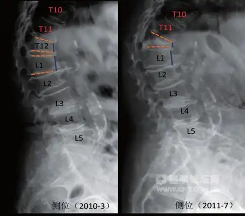 椎体压缩性骨折的x线特征