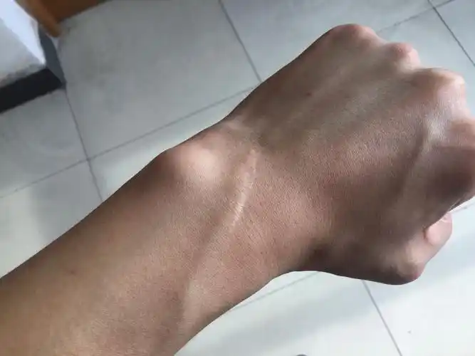 参军体检手腕部位有这样的瘢痕,倘若不经过手术处理可能合格并入伍吗?