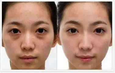 眼部|眼袋|黑眼圈_新浪新闻