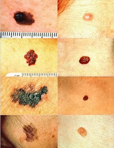 因为年轻的时候不懂防晒这位老爸患上了皮肤癌中最严重致死率高的癌症