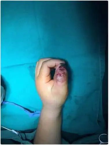 家长需注意9岁小孩大拇指上长小水泡导致手指坏死