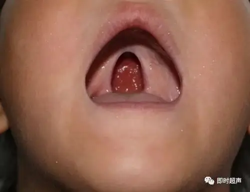 61左右侧上腭弓在中线部位未完全闭合所致单纯性腭裂61Ⅲ度唇裂