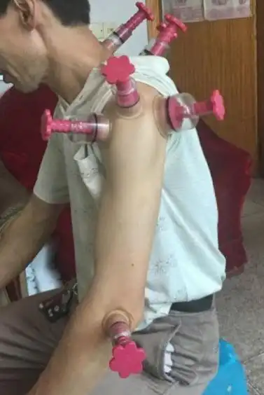 负压拔罐器治疗肩周炎
