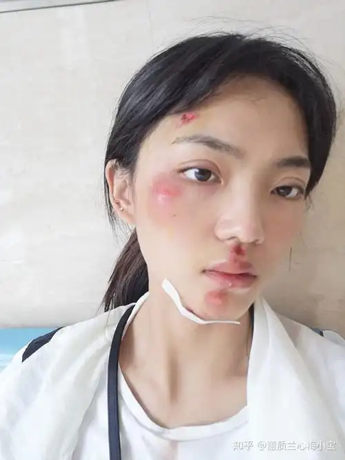 骑车摔伤面部手膝盖等如何处理不留疤