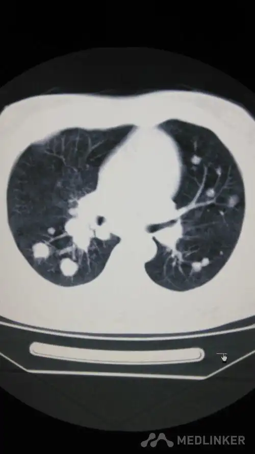 中央型肺癌肺内多发转移一例!