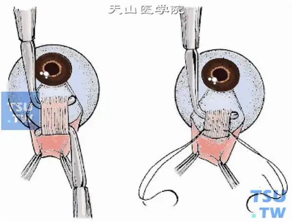 斜视直肌缩短术矫正操作及注意事项