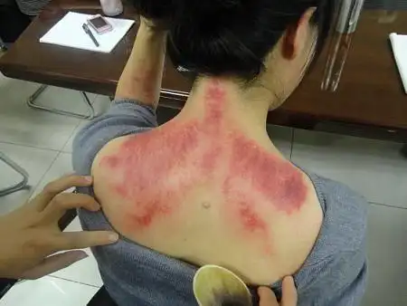 别有病网首期刮痧培训纪实