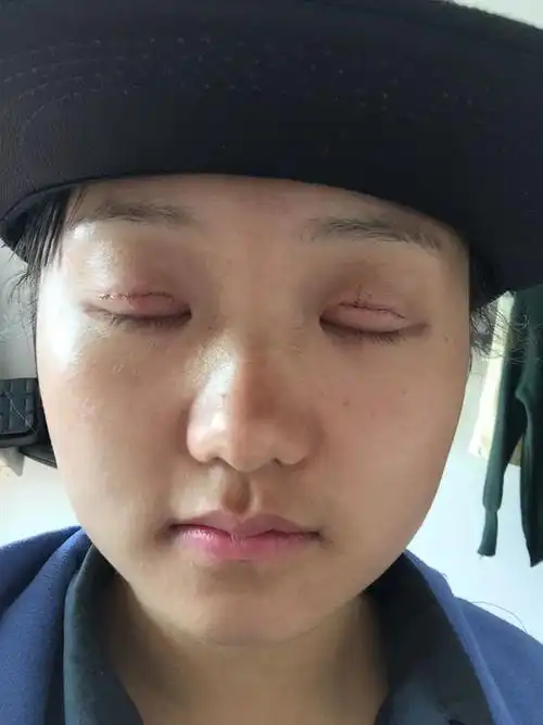 这是割完双眼皮第三天,宽不宽?什么形状的?