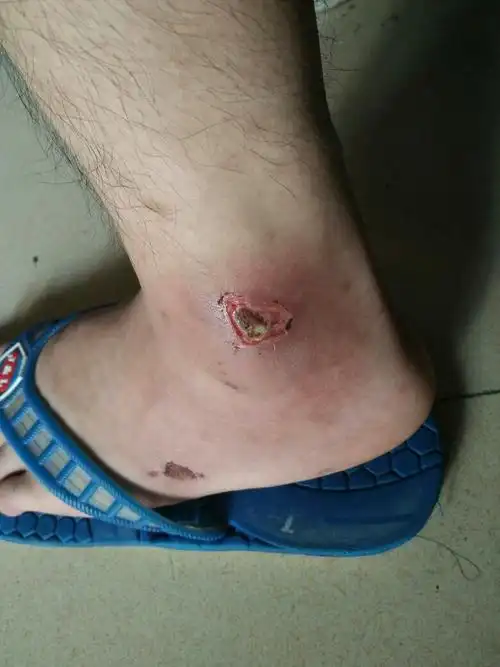 请问伤口有没有什么大问题 要不要怎么处理 我有一瓶德赛恩液体敷料