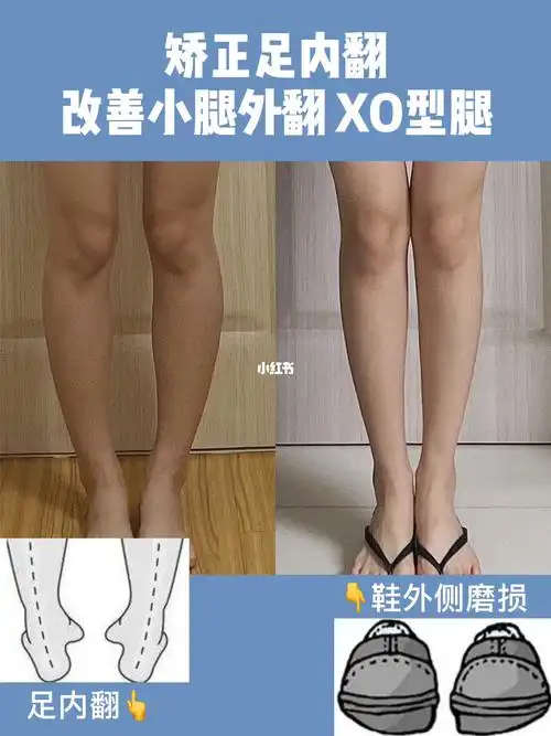 改善足内翻 小腿外翻 xo型腿 鞋外侧磨损_鞋子_青岛攻略_瘦腿_比目鱼