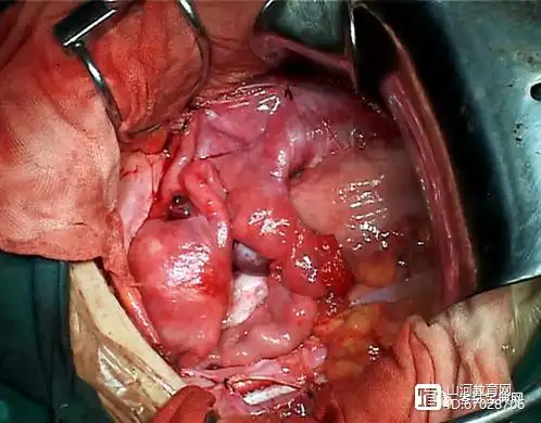 治疗性子宫颈锥切术Ⅰa1·手术方法:子宫颈锥切术或广泛性子宫颈切除