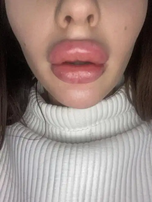 "那个美容师把溶解剂放进去后,用力按摩我的嘴唇,嘴唇都变白了,看起来