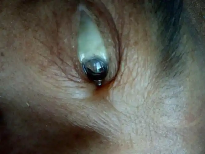 谁知道白眼球这样是什么问题