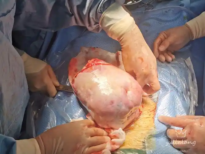 郎雁主任团队今天为她手术揭秘!