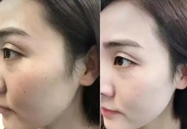 那么美白祛斑霜真的能去掉脸上的斑吗?