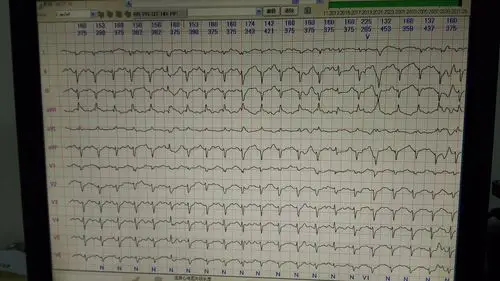 患者女性46岁 - 心电图脑电图专业讨论版 - 爱爱医医学论坛
