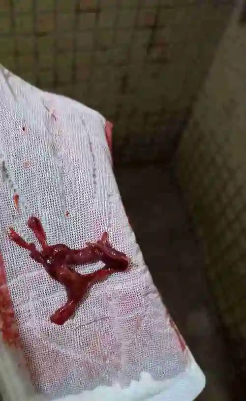 第二个月来了掉了一坨肉出来.第三个月,还是没有来月经担心