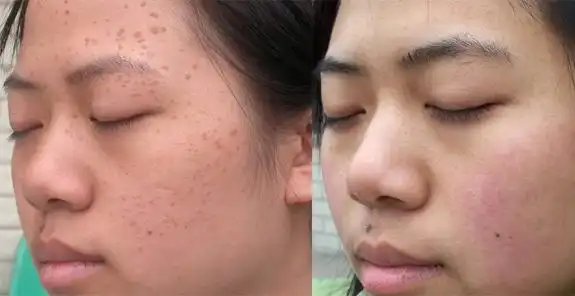 治疗扁平疣的药物_扁平疣的药_治疗扁平疣用什么药最好?_"【()