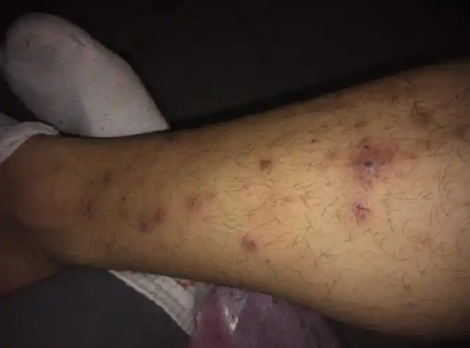 我皮肤上长了些胞,红的,有时间长的会发黑,平时没事,晚上睡觉