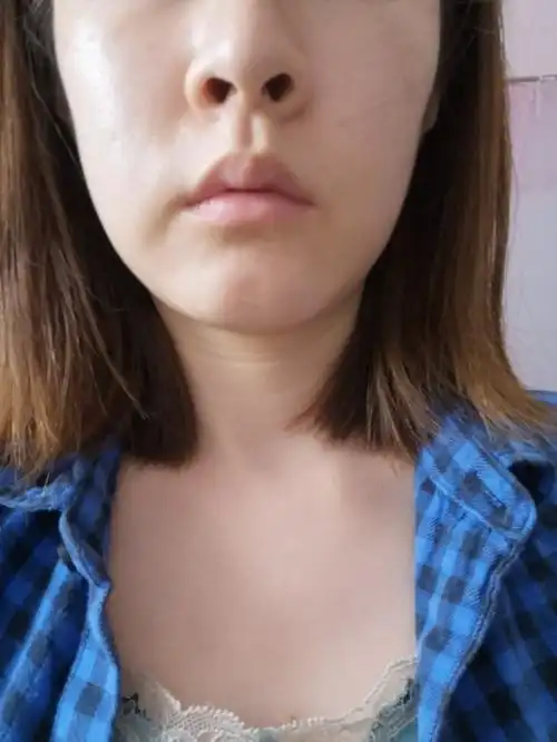 [:163]体验前变美诉求:嘴角嘟嘟肉,下垂较明显_圈子-新氧美容整形