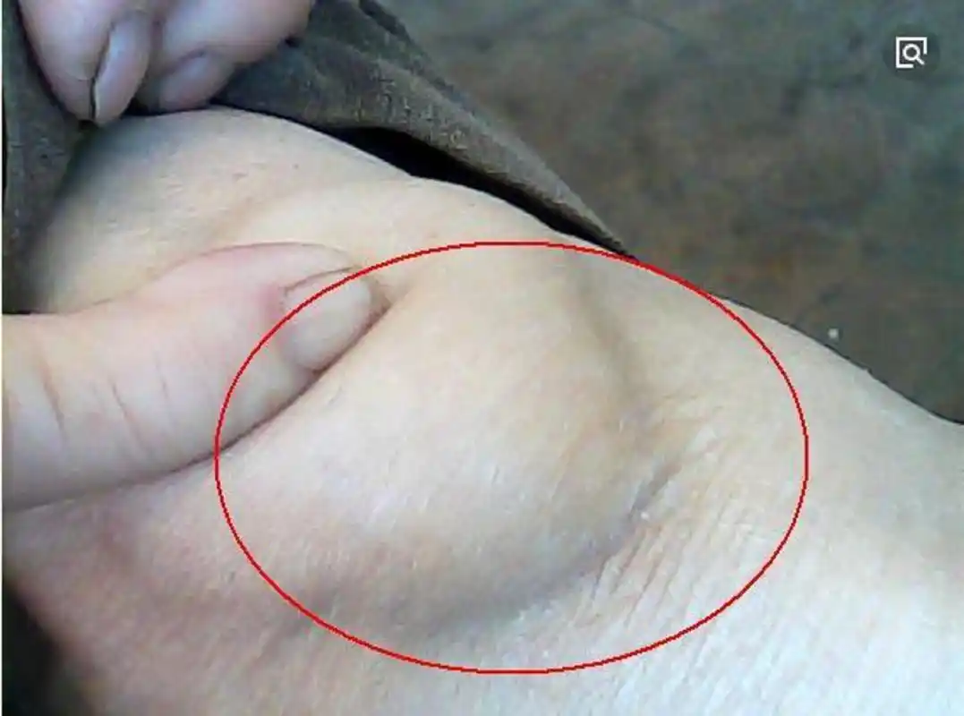 膝盖积液疼痛怎么办?康复者分享治疗经验!滑膜炎在家轻松解决!